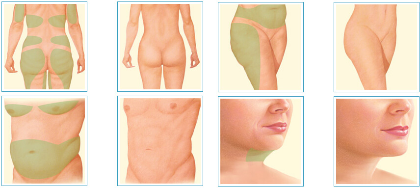 Liposuction (Yağ Aldırma) Ameliyat Bölgesinde Kesi Açma