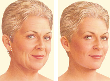 Yüz implantları